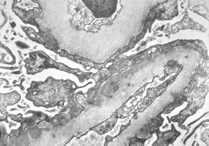M,39y. | membranous glomerulonephritis M,39y. | membranous glomerulonephritis